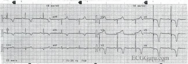 t-wave-inversion-ecg-guru-instructor-resources